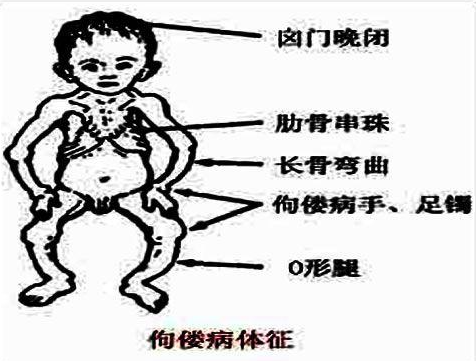 婴儿佝偻病的早期症状图片