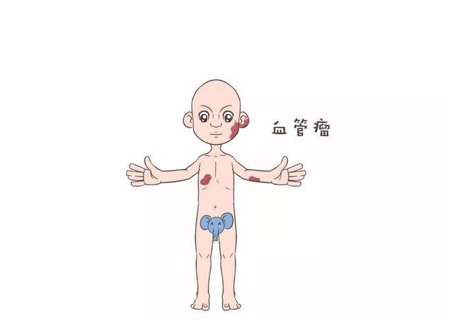 婴幼儿血管瘤