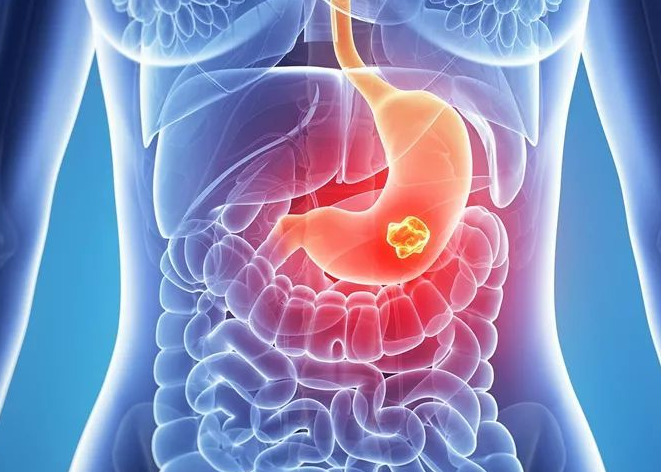 胃肠道间质瘤 