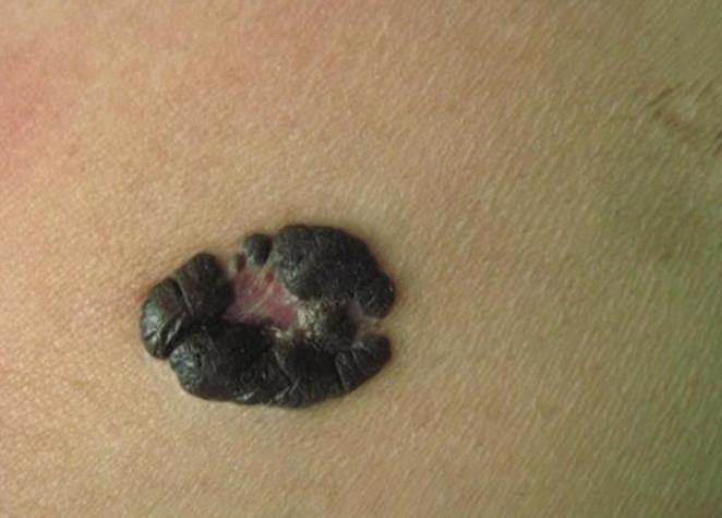 扁桃体黑色素瘤图片图片
