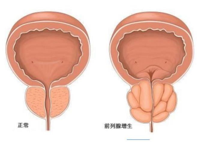 前列腺增生