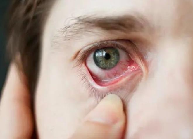 眼睛发红发痒总想揉传染性极强的角结膜炎怎么预防
