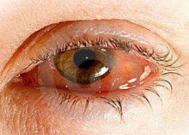 眼睛发红发痒总想揉传染性极强的角结膜炎怎么预防