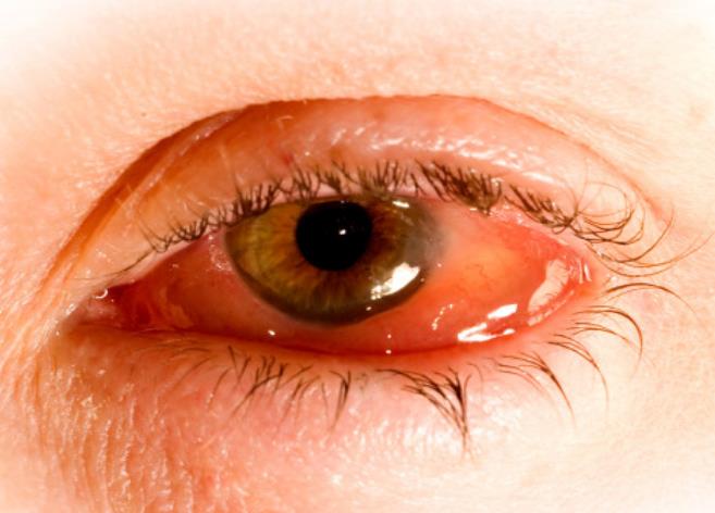 眼角膜炎图片和位置图片