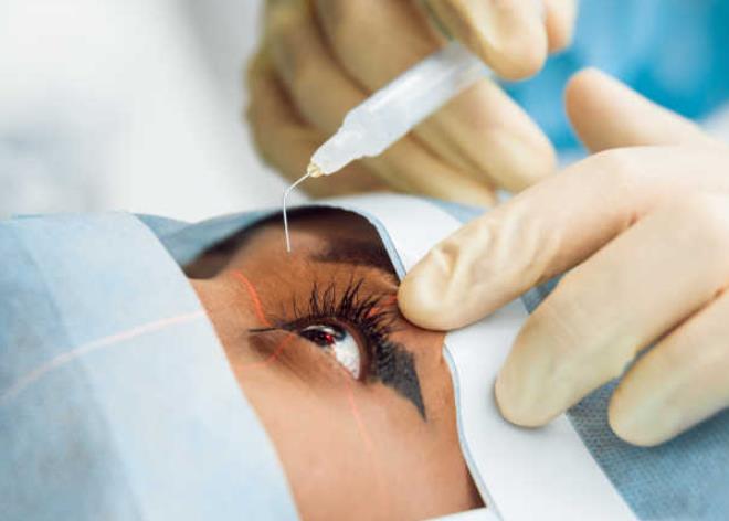 激光眼科手术