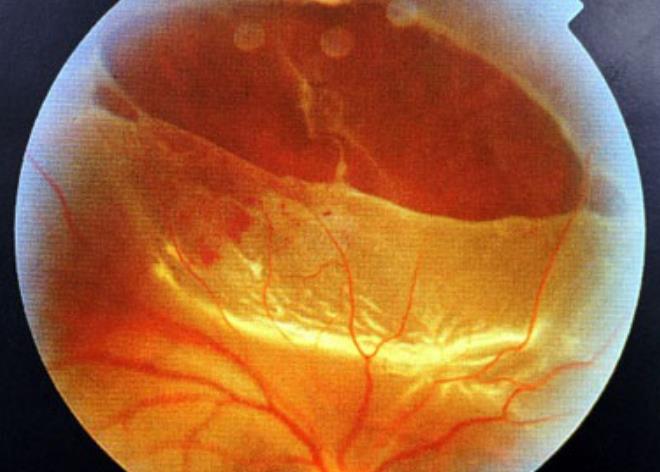 视网膜