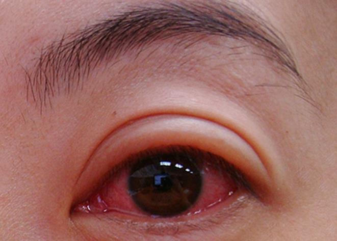 过敏性结膜炎类型多症状各有不同最常见为眼部发痒