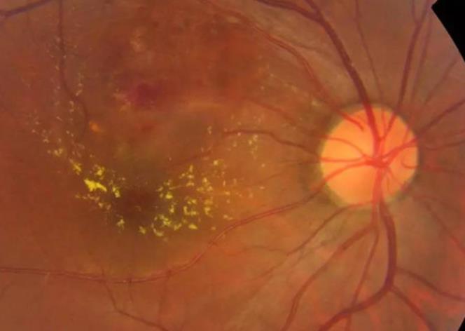 视网膜分支静脉阻塞
