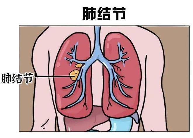 肺结节