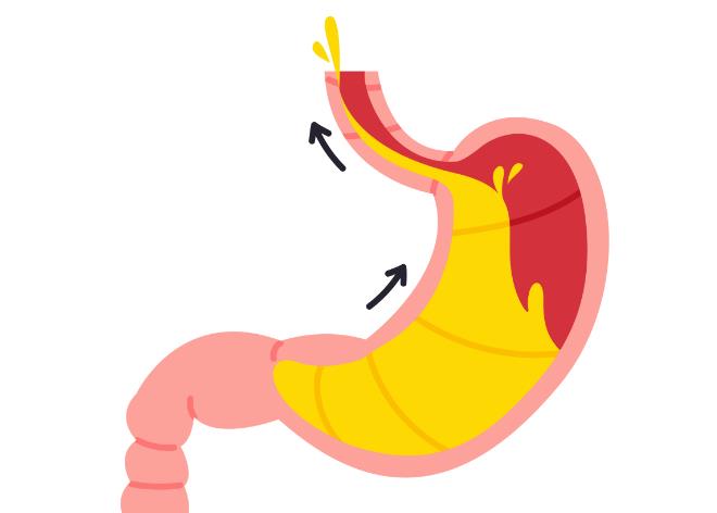 胃食管反流