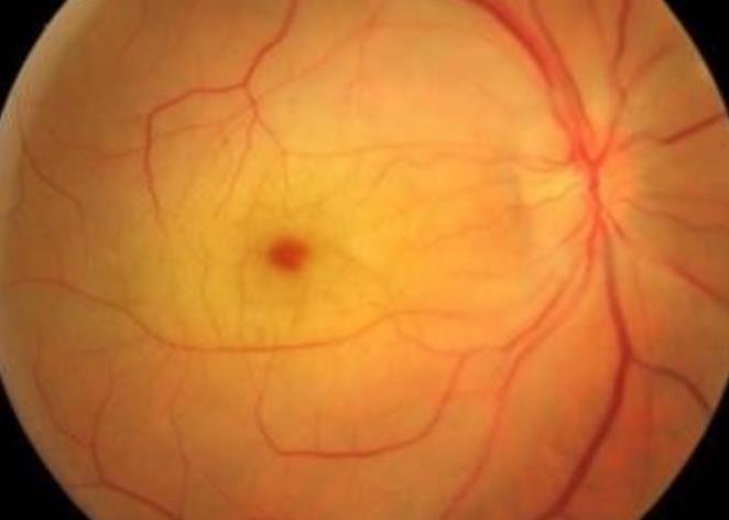 视网膜动脉阻塞