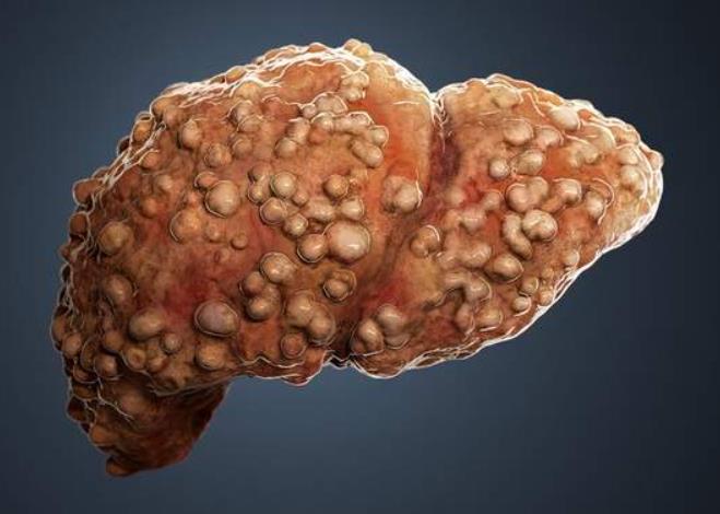肝癌黄疸图片晚期图片