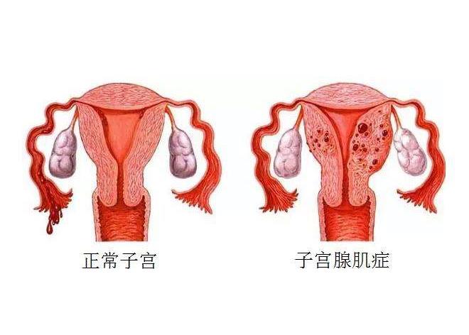 子宫内膜消融